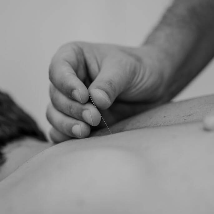 Electro Dry Needling - South Melbourne